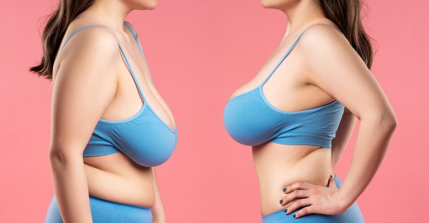 lifting des seins
